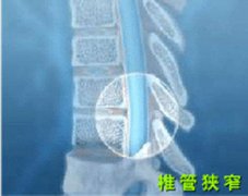 椎椎管狭窄怎么治疗